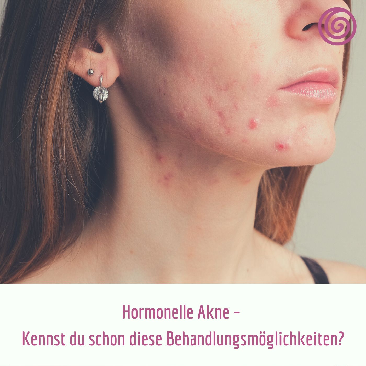 Hormonelle Akne –  Kennst du schon diese Behandlungsmöglichkeiten?