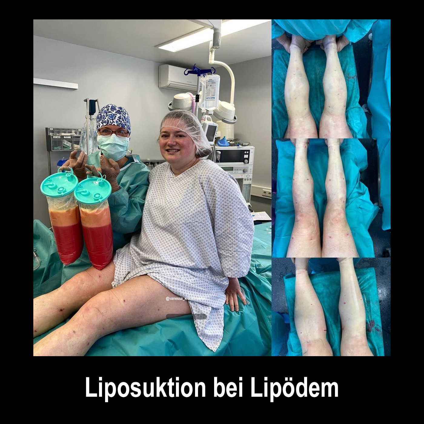 Liposuktion bei Lipödem episode artwork