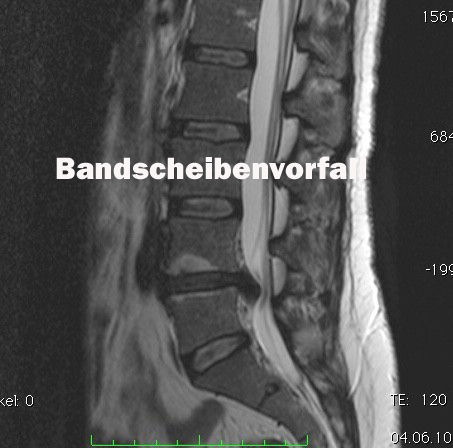 Der Bandscheibenvorfall an der Lendenwirbelsäule episode artwork