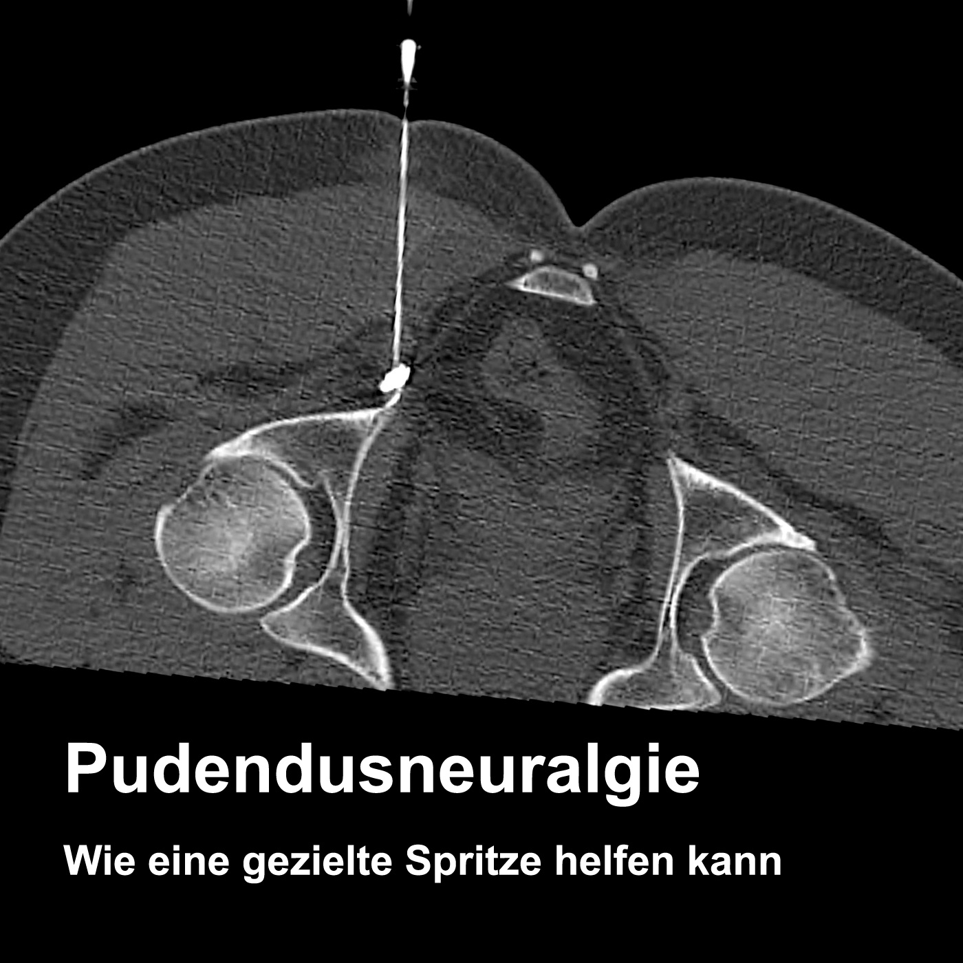 Pudendusneuralgie – Wenn der Nerv im Becken schmerzt