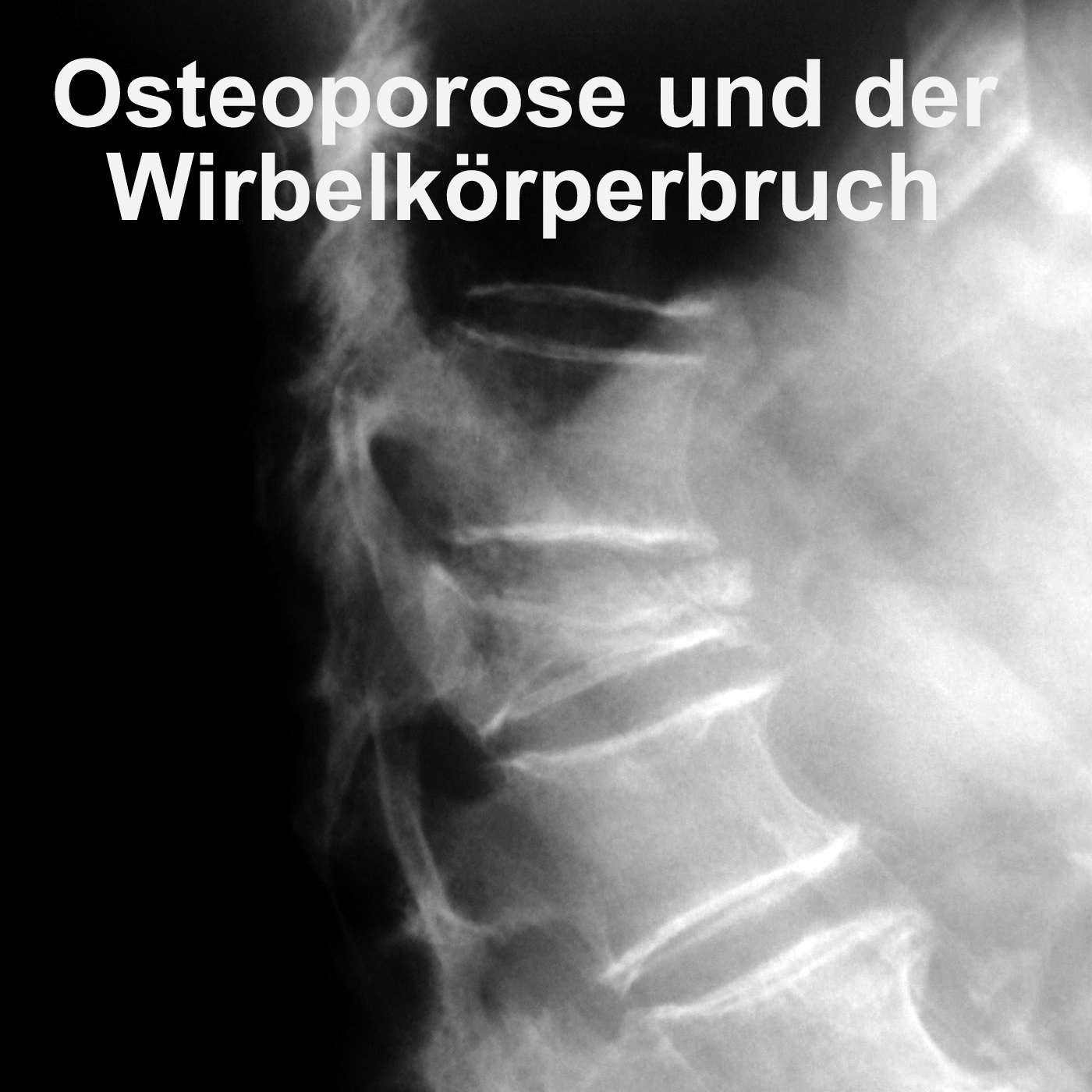 Osteoporose - der Knochenschwund beginnt früher, als Sie denken