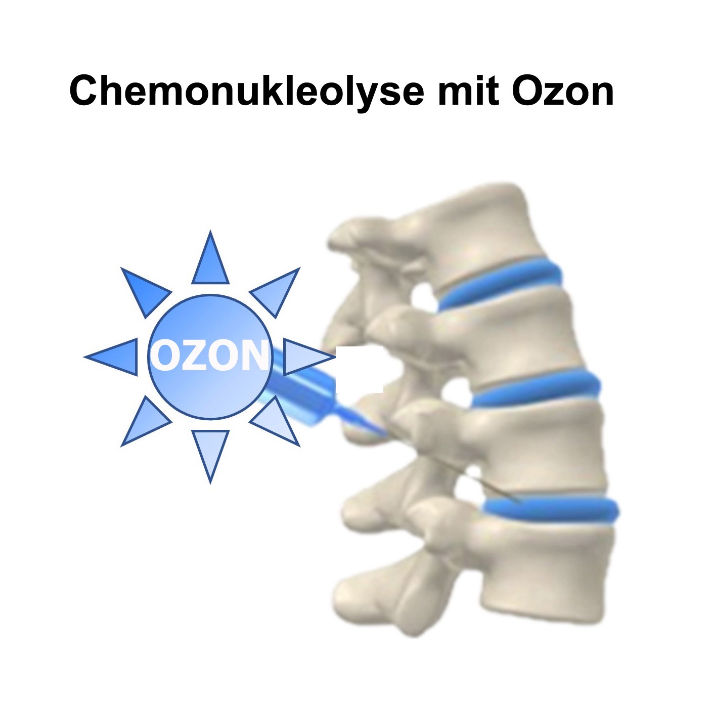 Die Ozontherapie des Bandscheibenvorfalls