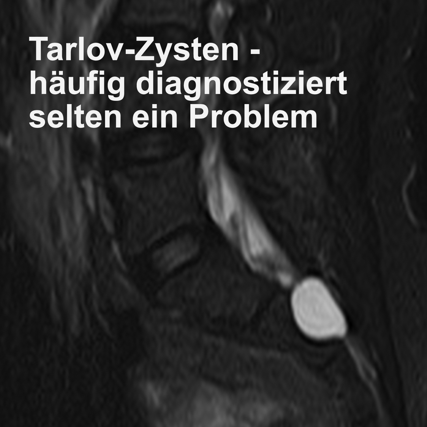 Tarlov-Zysten - häufig diagnostiziert selten ein Problem