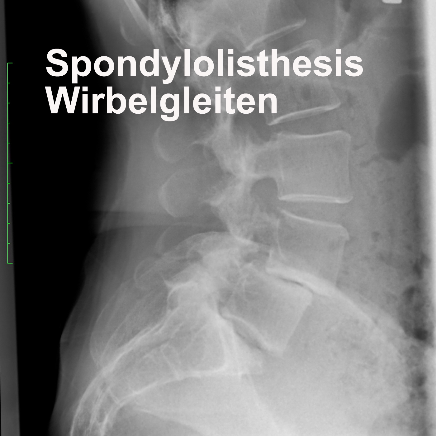 Spondylolisthesis - Wirbelgleiten