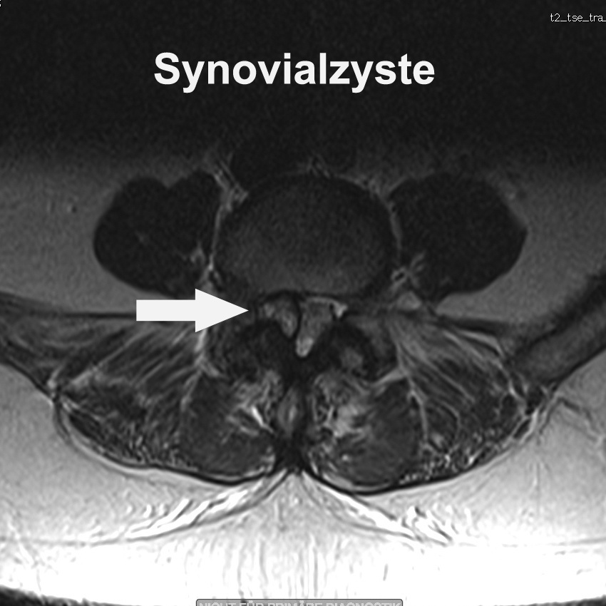 Synovialzysten - Wenn Schleimblasen auf Nerven drücken.