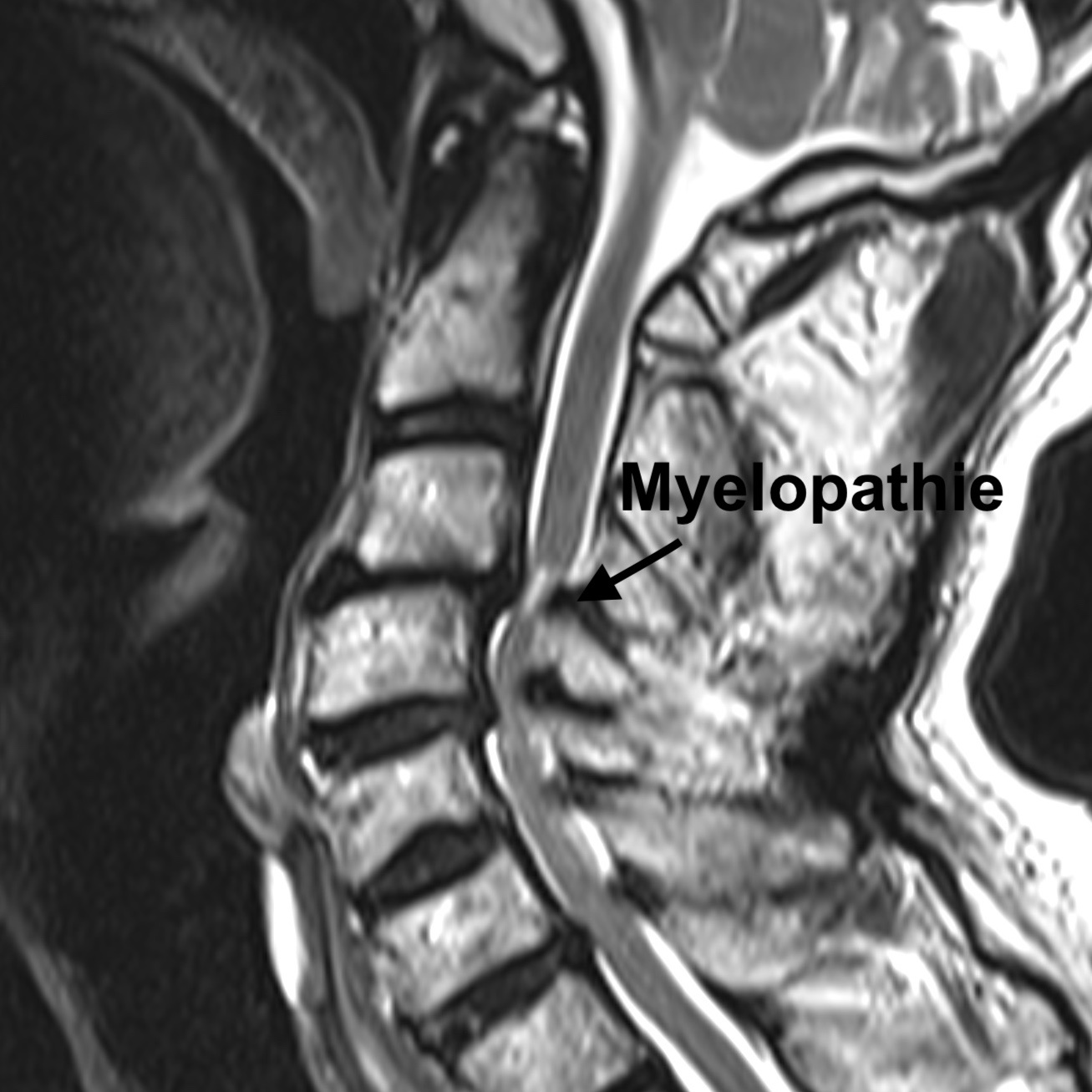 Die  Spinalkanalstenose - Einengung des Wirbelkanals an der Halswirbelsäule
