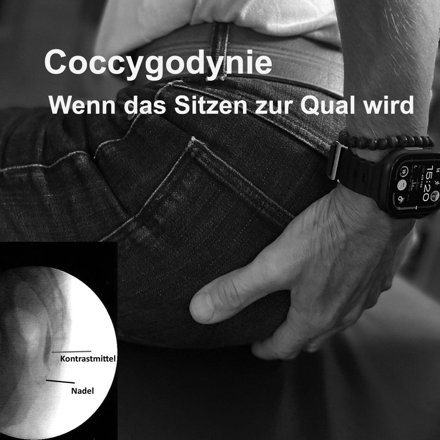 Coccygodynie - Wenn das Sitzen zur Qual wird