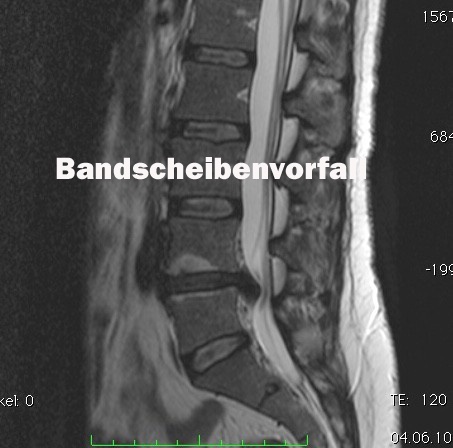 Der Bandscheibenvorfall an der Lendenwirbelsäule