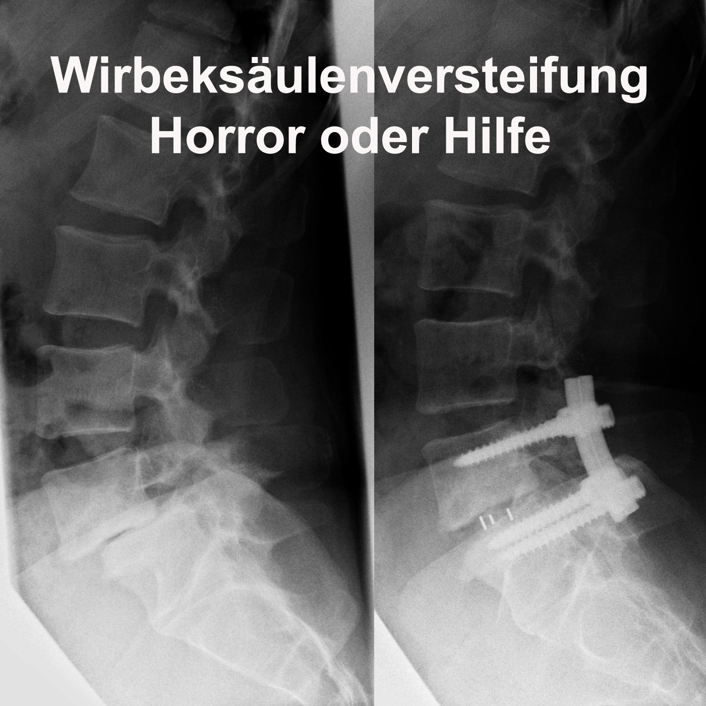 Wirbelsäulenversteifung - Horror oder Hilfe